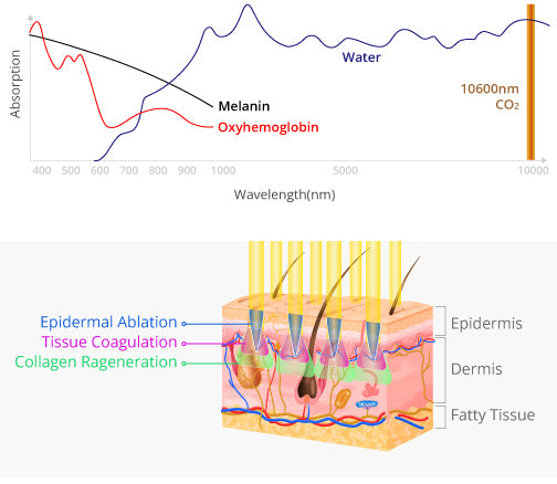 FDA Approved Super Pulsed CO₂ Laser Resurfacing Machine | Proffesional Skin Resurfacing & Vaginal Tightening Device
